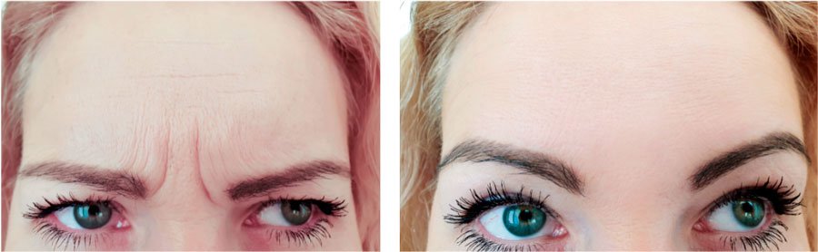 Imagen del antes y el después de la aplicación de sustancias neuromoduladoras para disminuir las arrugas de expresión en la frente.