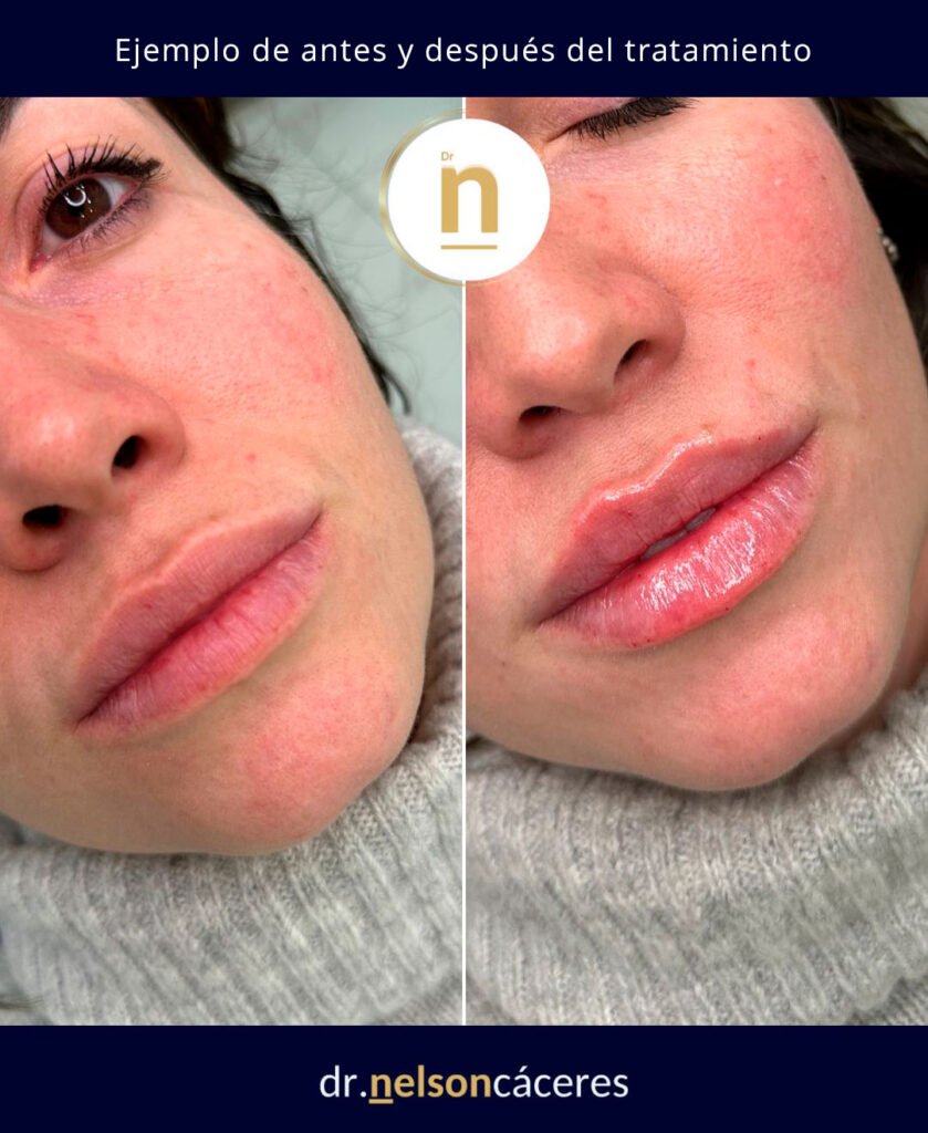 Ejemplo de antes y después de un tratamiento de aumento de labios con ácido hialurónico.